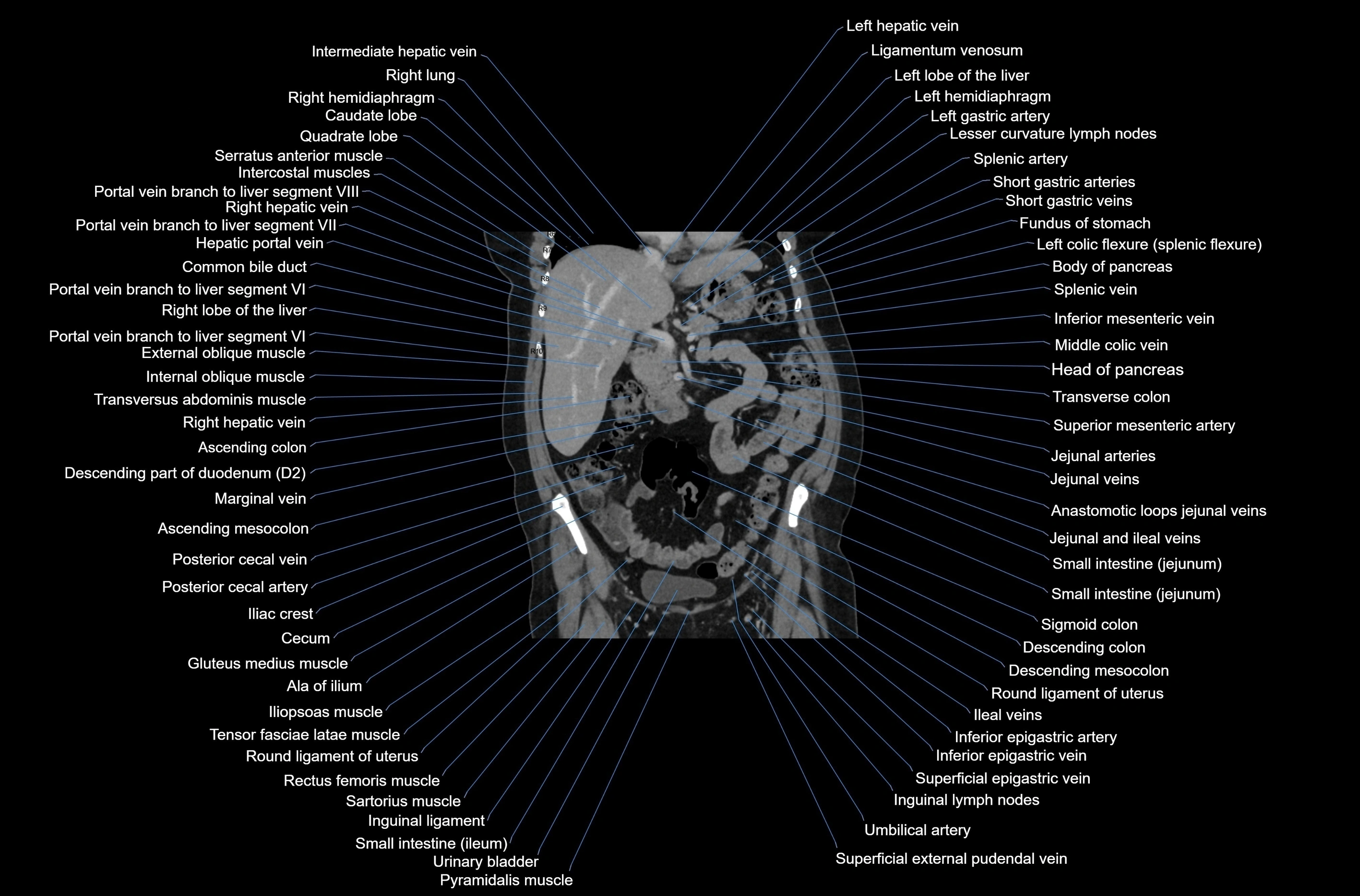CT abdomen coronal cross sectional anatomy labelled radiology image-00037.webp
